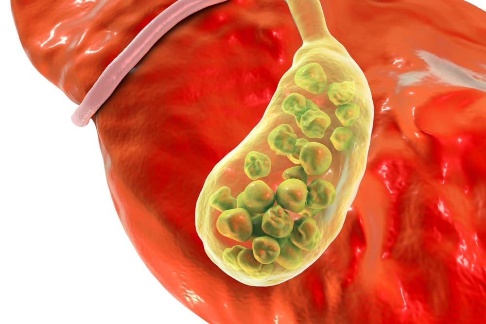 Piedras en la vesícula en Juárez, Chihuahua